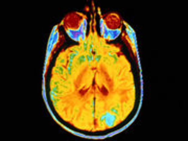 How Does Alzheimer's Disease Develop?