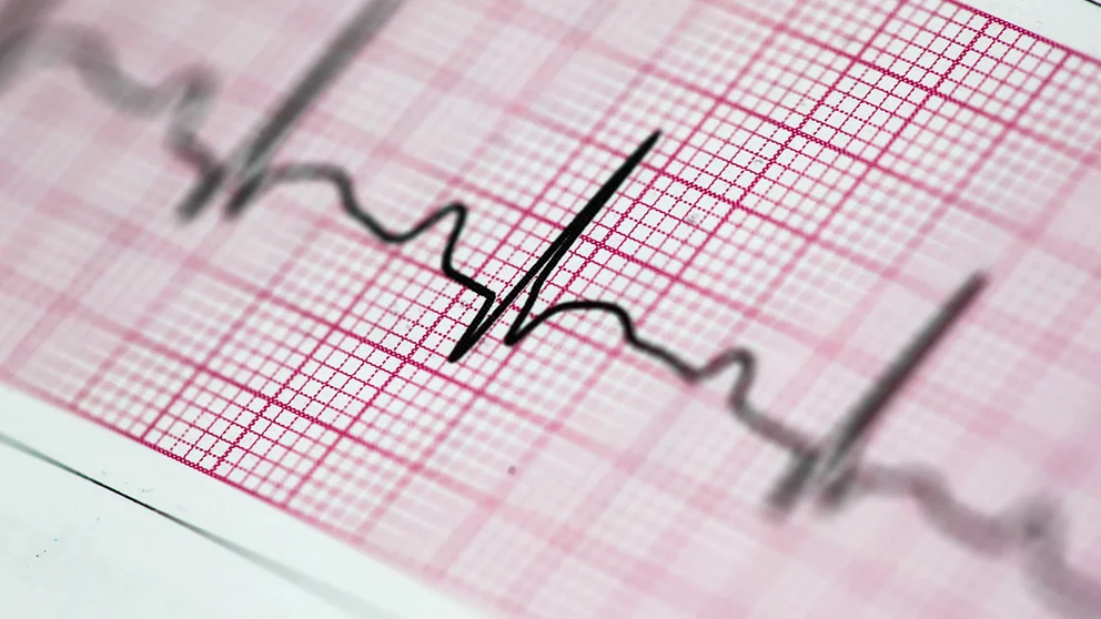 Controlling Inflammation Can Help You Lower Your Risk for Heart Attack and Stroke