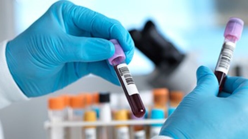 Inflammation Marker Laboratory