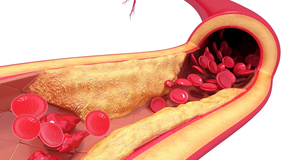 Heart valve