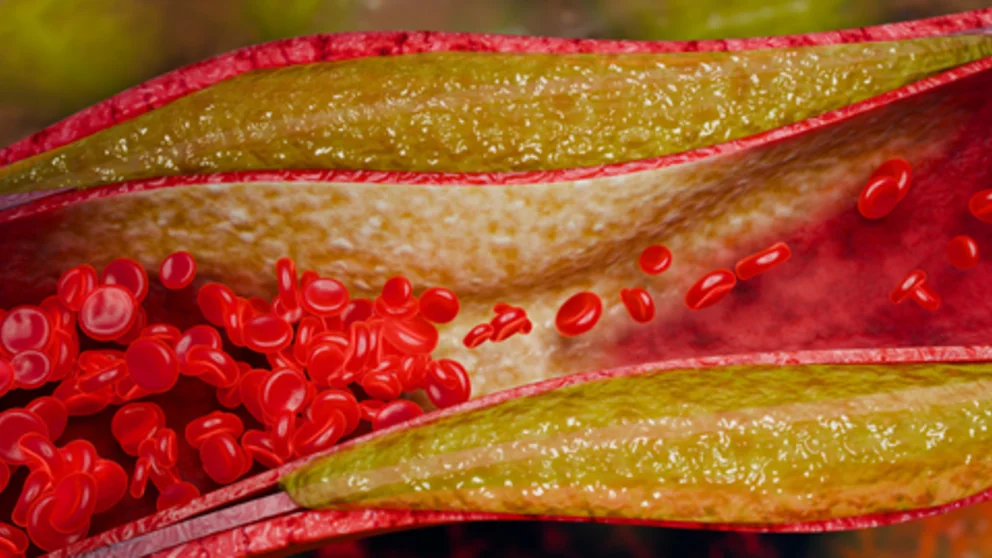 Blood vessel obstruction caused by fatty cholesterol buildup demonstrating reduced circulation, vascular inflammation, and increased risk of coronary artery disease and stroke. 3D Rendering