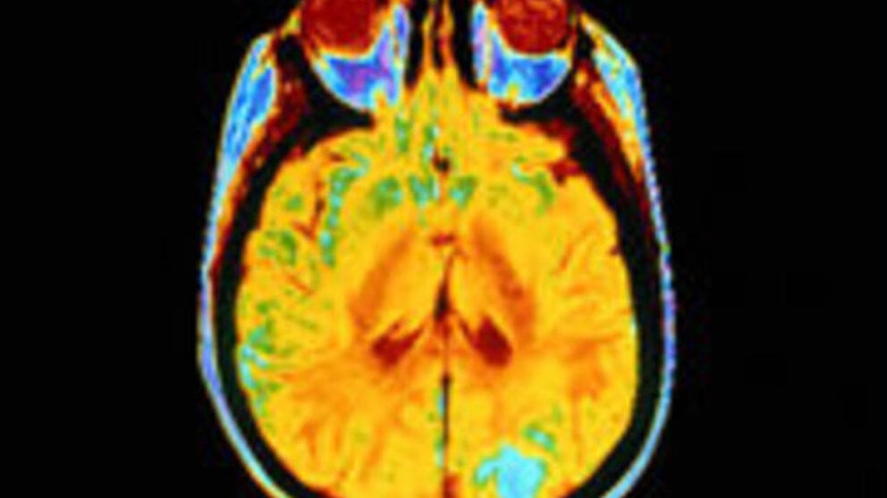 How Does Alzheimer's Disease Develop?