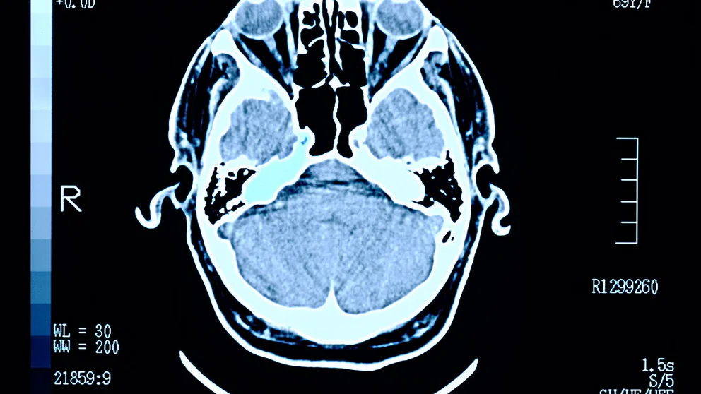 Cognitive Decline