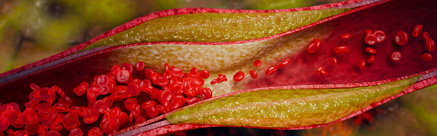 Blood vessel obstruction caused by fatty cholesterol buildup demonstrating reduced circulation, vascular inflammation, and increased risk of coronary artery disease and stroke. 3D Rendering
